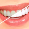 Teeth Whitening In Gurgaon